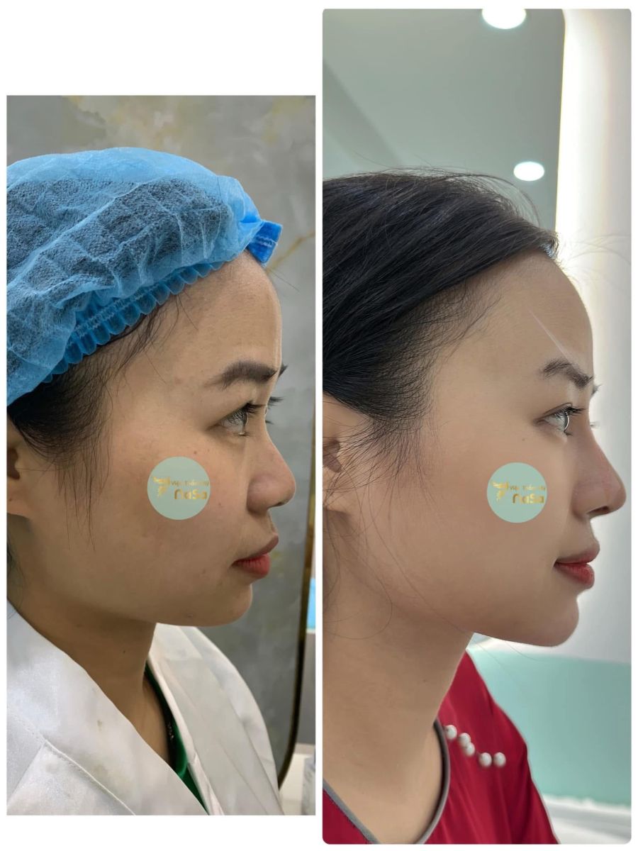 So sánh 2 phương pháp nâng mũi: Phẫu thuật truyền thống và nâng mũi hiện đại